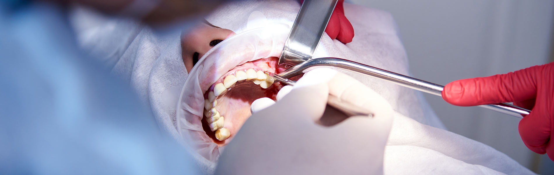 The image depicts a medical setting with a person receiving dental treatment, featuring a dentist performing a procedure on a patient s teeth while wearing protective gloves and equipment.