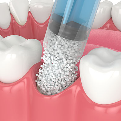 The image shows a close-up view of a dental implant process with a blue syringe dispensing small beads, which are likely to be dental implant screws, into an open mouth model with visible teeth and gum structure.