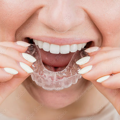 The image shows a person with clear teeth aligners on their upper teeth, smiling at the camera with their mouth open slightly, revealing the transparent plastic braces.