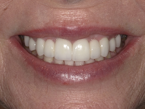 The image shows a close-up of an older individual s smiling face with visible teeth, capturing a moment of joy or contentment.