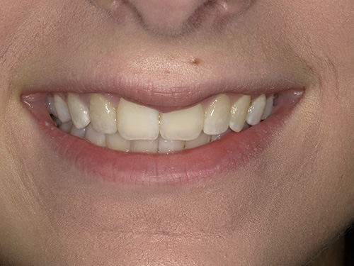 The image shows a close-up of a person smiling with a focus on their teeth and mouth area.