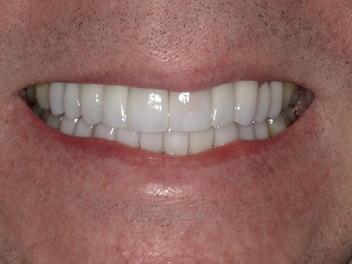 The image shows a close-up of a person s face with a smile revealing white teeth and gums, set against a neutral background.
