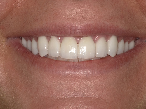 The image shows a close-up of a person s smiling face with teeth, focusing on their mouth and upper lip area.