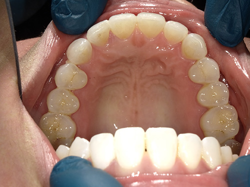 The image shows a close-up view of an open mouth with teeth, gums, and tongue visible.