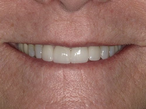 The image displays a close-up of a person s face showing a smiling mouth with white teeth and pink gums, against a blurred background that suggests a human figure.