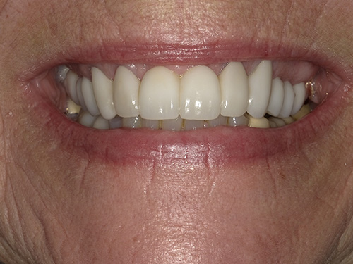 The image shows a close-up of a person's face with a focus on their teeth, which are prominently visible and appear well-maintained.