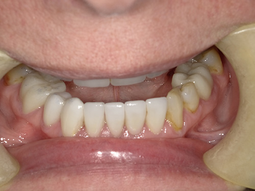 The image shows a set of human teeth with yellow stains, possibly indicating poor oral hygiene or the need for dental care.