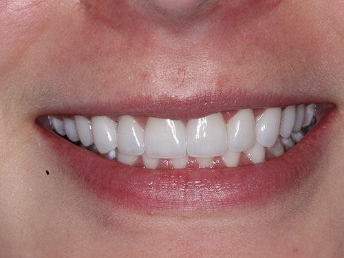 The image shows a close-up of a person's smiling face with straight white teeth, revealing a partial view of a nose and chin, against a neutral background.