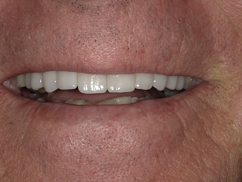 The image shows a close-up view of an elderly man's face with a broad smile, revealing his teeth and a partial denture on the lower left side.
