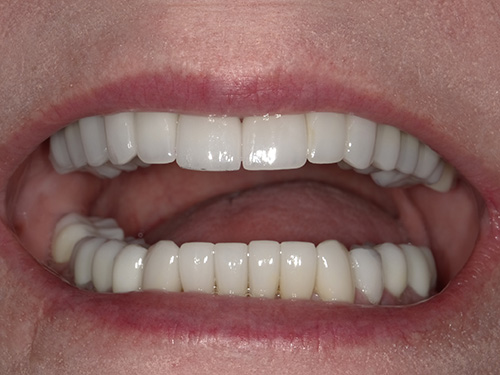 The image shows a close-up of a person's smiling mouth with white teeth and pink gums, displaying a wide smile.