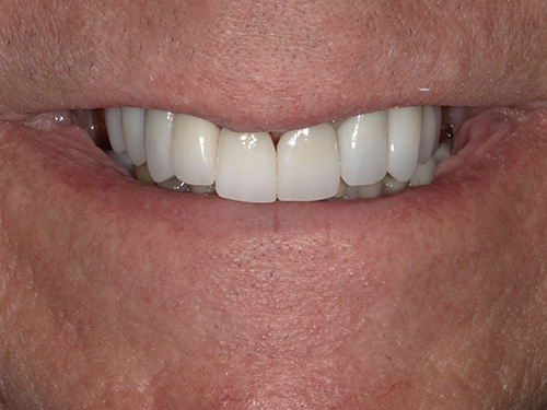 The image shows a close-up view of an older individual's face with a wide smile revealing white teeth and gums, set against a neutral background.