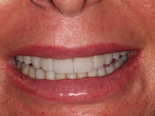 The image shows a close-up view of a person's smiling face with teeth and lips visible, against a neutral background.