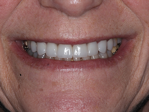 The image shows a close-up view of an older individual's smiling face with white teeth, set against a neutral background.