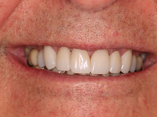 Flex Family Dentistry | Surgical Extractions, Teeth Whitening and Emergency Treatment