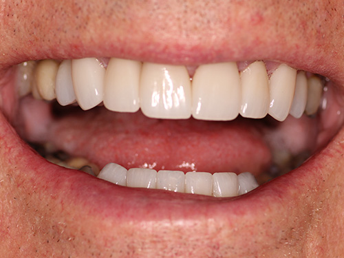 Flex Family Dentistry | Dentures, Oral Exams and Dental Bridges