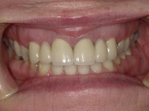 The image shows a close-up view of a person s mouth with a wide smile revealing white teeth and pink gums, against a blurred background that seems to be indoors.