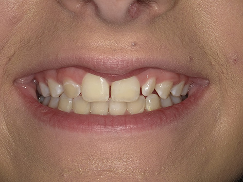 The image shows a close-up of a person s smiling face with teeth, set against a blurred background.