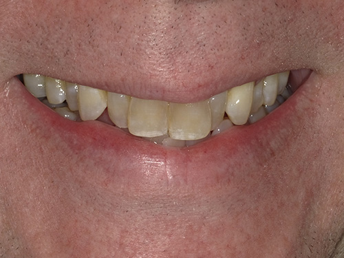 The image shows a close-up view of a person s smiling face with teeth, featuring a mustache and a partial view of the person s chin.