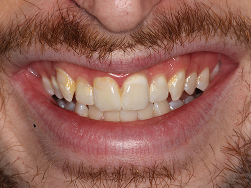 The image displays a close-up of a person with a beard showing a wide smile revealing yellowed teeth.