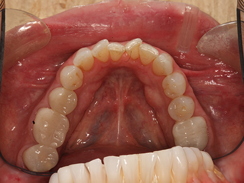 The image shows a close-up view of an open mouth with teeth and gums visible, featuring a dental impression tray inserted into the oral cavity.