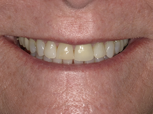 The image shows a close-up of a person s smiling face with white teeth and a yellowish-brown stain on the lower front tooth, which appears to be a dental implant.