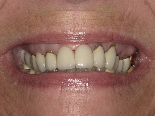 The image shows a close-up of a person s face with an open smile revealing yellowed teeth and gums, against a blurred background.