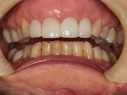 The image shows a close-up view of an open mouth with teeth that appear to be discolored or stained, possibly due to a medical condition or dental issues, against a backdrop of a person's hand holding the upper lip slightly upwards.