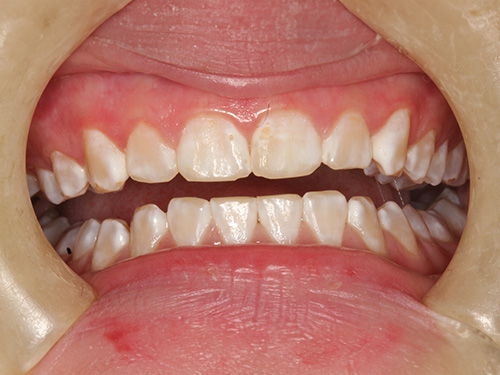 The image shows a person's lower teeth with a noticeable gap between them, set against a background that appears to be a human face, possibly from a mask or dummy head, due to the visible facial features such as eyelashes and lips.