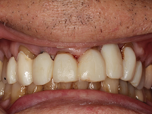 An image showing a close-up view of a person's mouth displaying a wide smile with yellowed teeth, revealing a dental implant on one side.