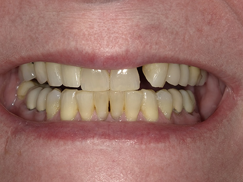 An elderly person with a wide smile displaying yellowed teeth, some missing, and a partial denture.