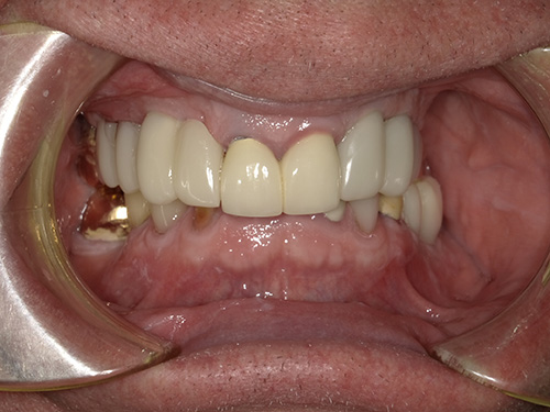 The image shows a close-up view of a person's teeth with a focus on dental work, including visible fillings, braces, and possibly other orthodontic appliances. The individual appears to be wearing a partial denture in the upper arch.