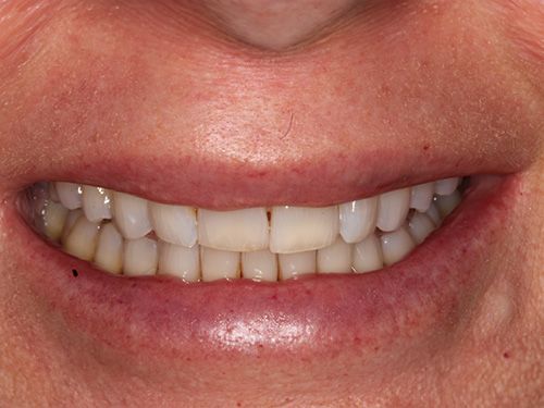 The image shows a close-up of an adult person smiling with teeth visible, revealing some dental work including a bridge or implant on the upper front teeth.