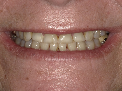 A close-up photograph of an older individual's lower face with a wide smile, revealing yellowed teeth and signs of age.