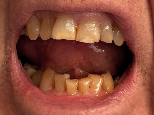 Flex Family Dentistry | Occlusal Orthotic Appliances, Root Canals and Snoring Appliances