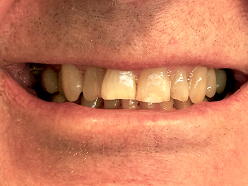 Flex Family Dentistry | Orthodontic Extractions, Ceramic Crowns and Jeuveau reg Tox Treatments